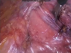 Laparoscopic Ultra Low Anterior Resection With Coloanal Stapled Anastomosis for Low Rectal Cancer Laparoscopic Ultra Low Anterior Resection With Coloanal Stapled Anastomosis for Low Rectal Cancer