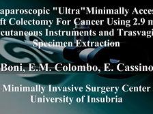 Laparoscopic "Ultra" Minimal Left Colectomy With Micro-Instruments & Transvaginal Extraction Laparoscopic "Ultra" Minimal Left Colectomy With Micro-Instruments & Transvaginal Extraction