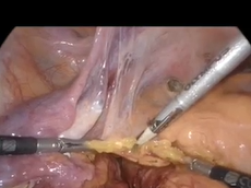 Laparoscopic Ultralow Anterior Resection with Intersphincteric Dissection & Delayed Anastomosis Laparoscopic Ultralow Anterior Resection with Intersphincteric Dissection & Delayed Anastomosis