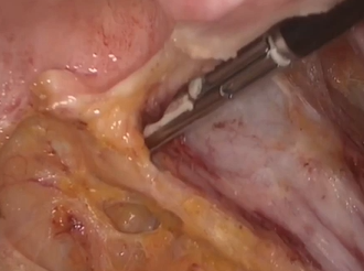 Laparoscopic vaginal suspension and rectopexy for rectal prolapse