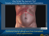 LAPAROSCOPIC VENTRAL HERNIA REPAIR IN A LIVER TRANSPLANT PATIENT