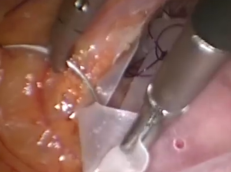 Laparoscopic Ventral Mesh Rectopexy after Hysteropexy