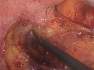 Laparoscopic Ventral Mesh Rectopexy for Male Patient with Rectal Prolapse