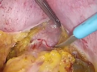 Laparoscopic ventral mesh rectopexy for rectal prolapse and obstructed defaecation Laparoscopic ventral mesh rectopexy for rectal prolapse and obstructed defaecation