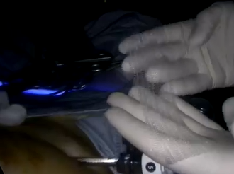 Laparoscopic Ventral Mesh Rectopexy