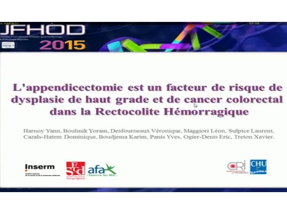 L'appendicectomie est un facteur de risque de dysplasie de haut grade et de cancer colorectal dans la rectocolite hémorragique