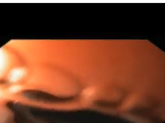 Large Bleeding Gastro-jejunal Anastomotic Ulceration after Gastric Bypass