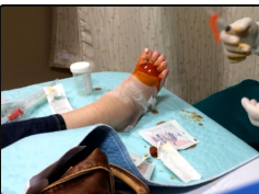 Large blood blister drainage