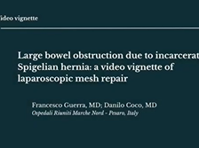 Large Bowel Obstruction due to incarcerated Spigelian hernia: a video vignette of lap mesh repair Large Bowel Obstruction due to incarcerated Spigelian hernia: a video vignette of lap mesh repair