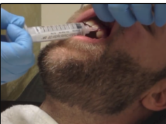 Large Facial Abscess