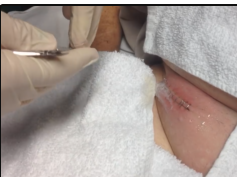 Large PostSurgical Wound Infection - Abscess