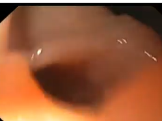 Large Staple Line Leak after Sleeve Gastrectomy