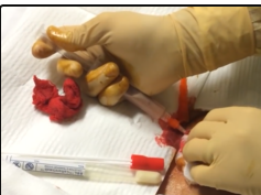 Largest Abscess I've EVER drained - YT sanctioned version