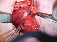 Laryngeal reinnervation by ansa cervicalis