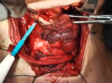 Laryngectomy: Partial Horizontal Supraglottic Open Laryngectomy
