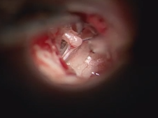 Laser stapedotomy for otosclerosis