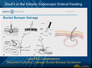Late PEG Complications: Recurrent Cellulitis, Leakage, Buried Bumper Syndrome