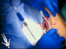 Lateral Approach for Peroneal Artery Exposure with Fibulectomy Lateral Approach for Peroneal Artery Exposure with Fibulectomy