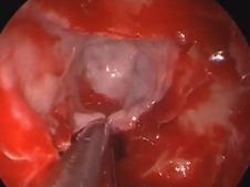Lateral Lamella Spontaneous CSF Leak Repair with Free Mucosal Graft