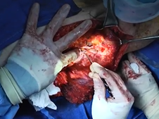 Latissimus dorsi free flap