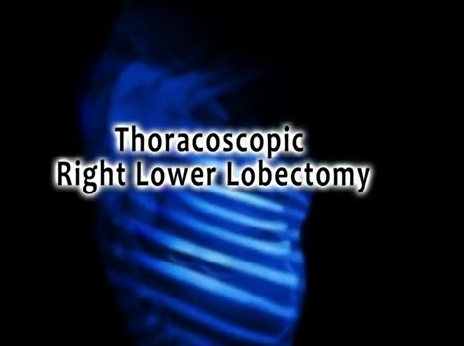 L'atlas du Dr Todd Demmy - lobectomie thoracoscopique - lobectomie inférieure droite L'atlas du Dr Todd Demmy - lobectomie thoracoscopique - lobectomie inférieure droite