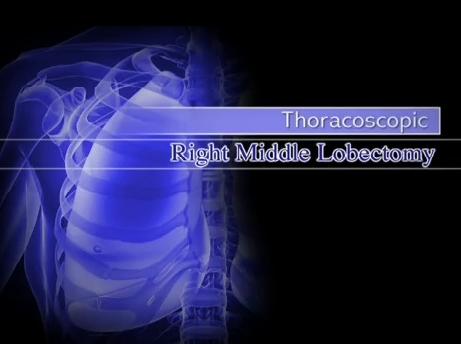 L'atlas du Dr Todd Demmy - lobectomie thoracoscopique - lobectomie milieu droit L'atlas du Dr Todd Demmy - lobectomie thoracoscopique - lobectomie milieu droit