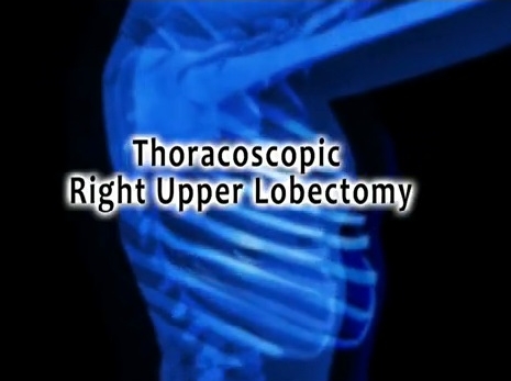 L'atlas du Dr Todd Demmy - lobectomie thoracoscopique lobectomie supérieure droite L'atlas du Dr Todd Demmy - lobectomie thoracoscopique lobectomie supérieure droite