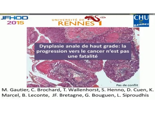 Le cancer invasif n’est pas une fatalité en cas de lésion malpighienne intraépithéliale de haut grade du canal anal
