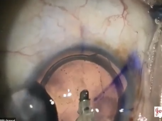 Learn all about Surgical Management of Astigmatism: LRIs, Toric IOL Implantation by DR. S.P.S GREWAL