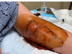 Left arm abscess drainage
