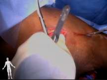 Left Cephalic Vein Turndown Left Cephalic Vein Turndown