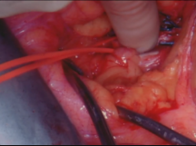 Left External Iliac Artery to Superior Mesenteric Artery Bypass Using GSV Left External Iliac Artery to Superior Mesenteric Artery Bypass Using GSV