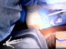 Left Iliofemoral DVT Thrombectomy Using ClotTriever Device Left Iliofemoral DVT Thrombectomy Using ClotTriever Device