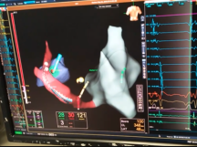 Left lateral accessory pathway ablation - decoded