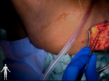 Left Upper Extremity Brachiobasilic Arteriovenous Fistula Creation Left Upper Extremity Brachiobasilic Arteriovenous Fistula Creation
