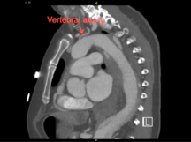 Left Vertebral Artery Transposition to Left Common Carotid Artery Left Vertebral Artery Transposition to Left Common Carotid Artery