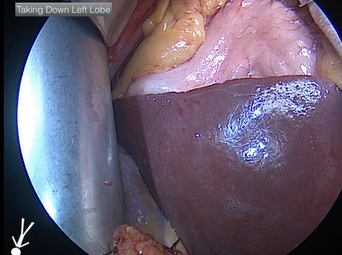 Left Visceral Rotation (Alan B. Lumsden, MD) Left Visceral Rotation (Alan B. Lumsden, MD)