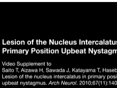 Lesion of the Nucleus Intercalatus in Primary Position Upbeat Nystagmus Lesion of the Nucleus Intercalatus in Primary Position Upbeat Nystagmus
