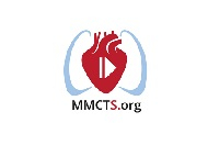 Less invasive implantation of HeartWare left ventricular assist device