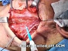 Level II-IV Select Neck Dissection