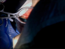 Ligation of Percutaneously Created Arteriovenous Fistula Ligation of Percutaneously Created Arteriovenous Fistula