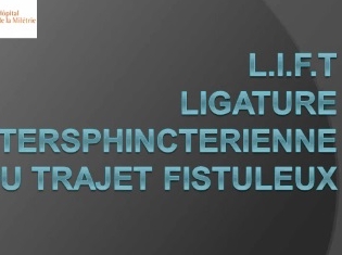 Ligature intersphinctérienne du trajet fistuleux (LIFT) Ligature intersphinctérienne du trajet fistuleux (LIFT)