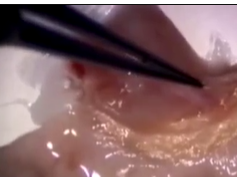 Limbal Allograft Transplantation Using Fibrin Glue Part 1 Limbal Allograft Transplantation Using Fibrin Glue Part 1