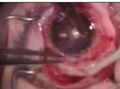 Limbal Allograft Transplantation Using Fibrin Glue Part 2 Limbal Allograft Transplantation Using Fibrin Glue Part 2