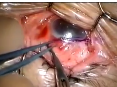 Limbal Block Suture Parallel Technique/Limbal Block Suture Cross Technique Part 1 Limbal Block Suture Parallel Technique/Limbal Block Suture Cross Technique Part 1