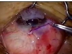 Limbal Block Suture Parallel Technique/Limbal Block Suture Cross Technique Part 2 Limbal Block Suture Parallel Technique/Limbal Block Suture Cross Technique Part 2