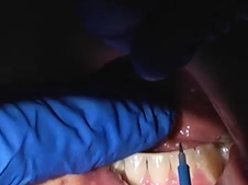 Lingual Frenulectomy