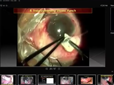 Live Webinar Glaucoma Surgical Panaroma
