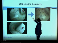 Long head of biceps in the shoulder-do we really need it? Long head of biceps in the shoulder-do we really need it?