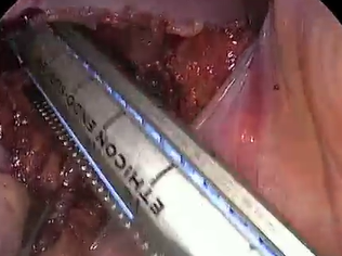 Low Anterior Resection and Near Infrared Technology